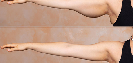 Arm Lift Surgery