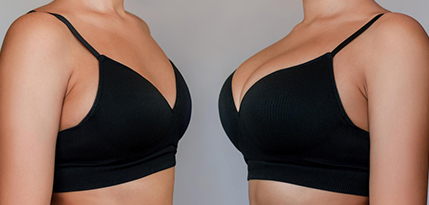 Breast Augmentation Surgery