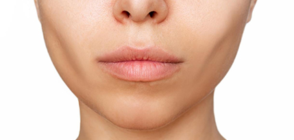Buccal Fat Removal Surgery