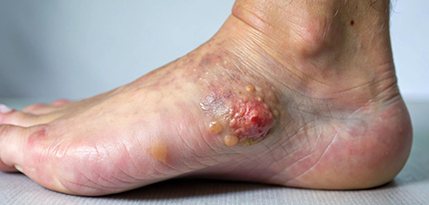 Diabetic Foot Surgery