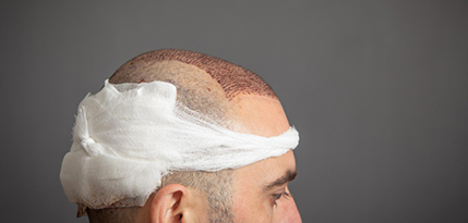 FUE Hair Transplant