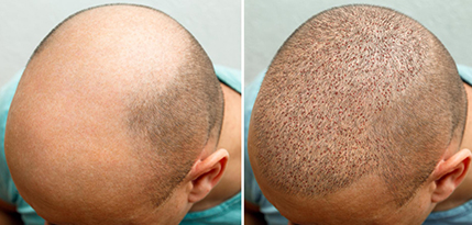 FUT Hair Transplant