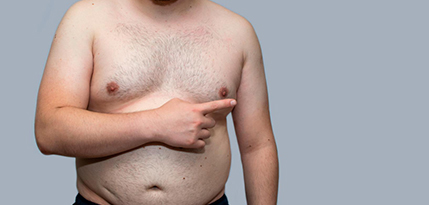 Gynecomastia Surgery