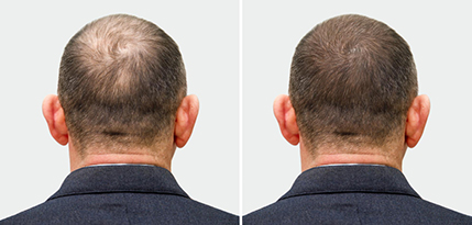 Hair Transplant
