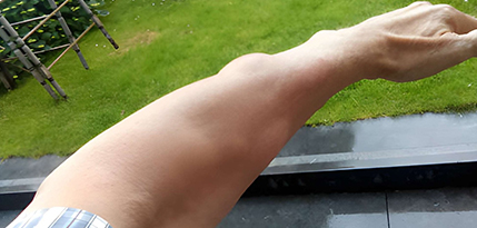 Lipoma Removal Surgery