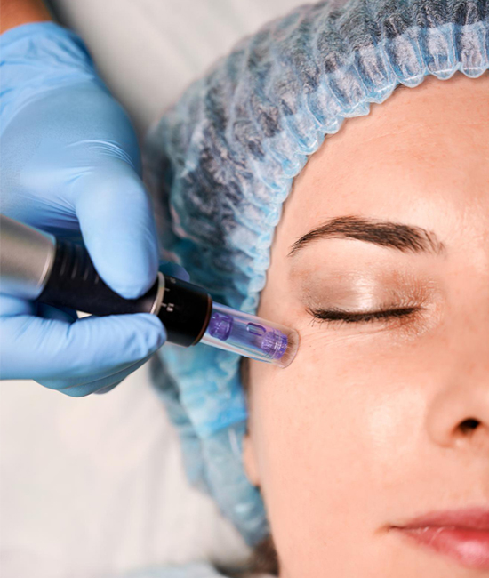 Microneedling treatment at WFY Plastic Surgery