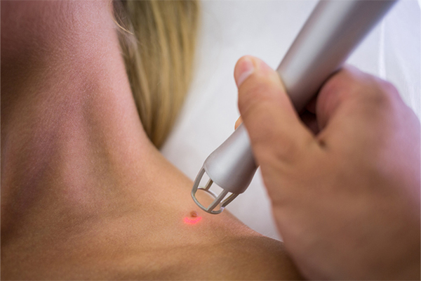 Mole Removal Treatment in Gurgaon