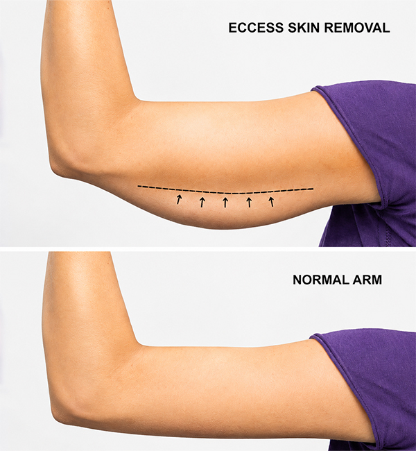 Arm lift surgery consultation and treatment planning