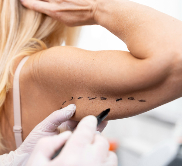 Arm Lift Surgery treatment at WFY Plastic Surgery