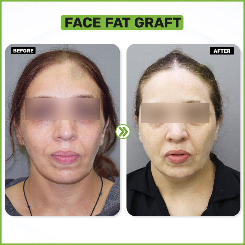 Before and After 1