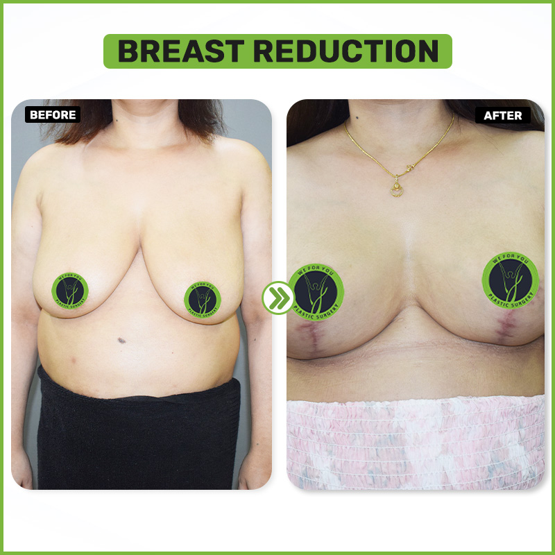 Before and After 11