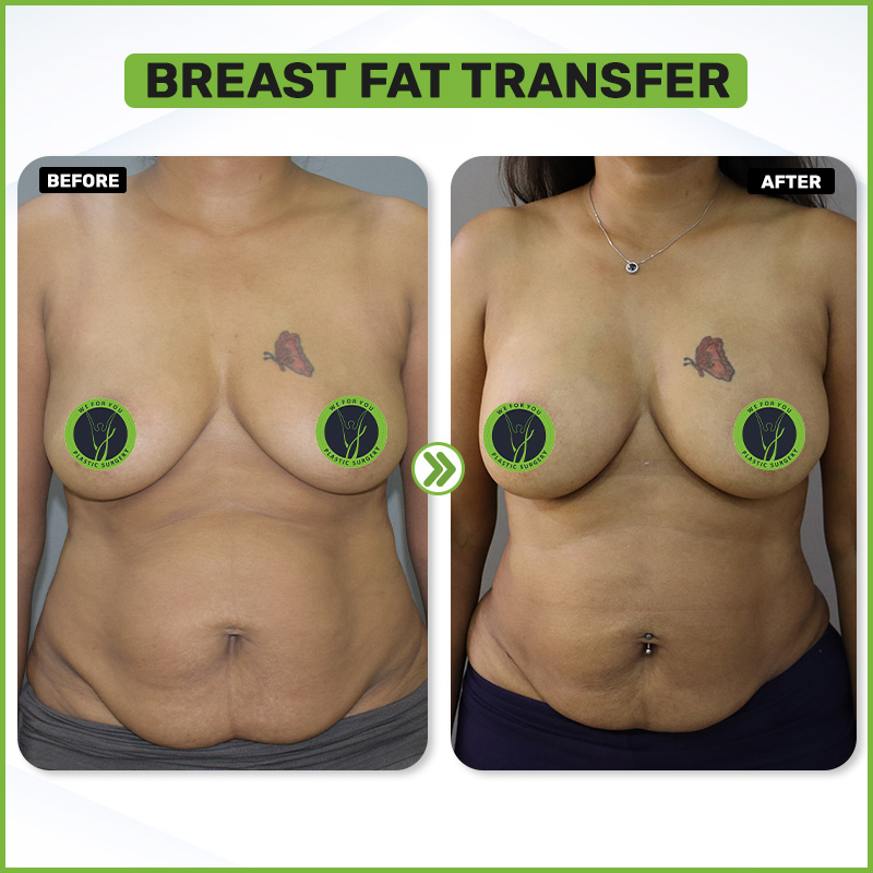 Before and After 3