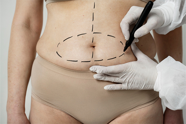 Belt Lipectomy Lower Body Lift Surgery in Gurgaon