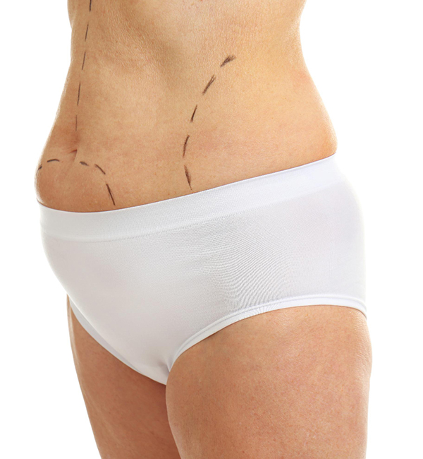 Belt Lipectomy Lower Body Lift treatment at WFY Plastic Surgery
