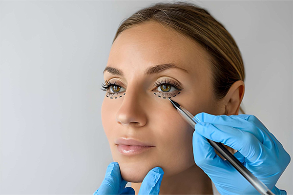 Blepharoplasty Eyelid Surgery in Gurgaon