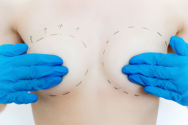 Breast Reduction Surgery in Gurgaon