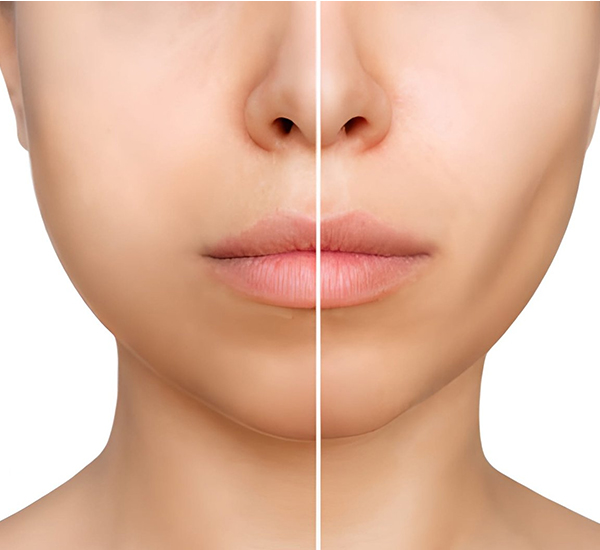 Buccal fat removal surgery consultation and treatment planning