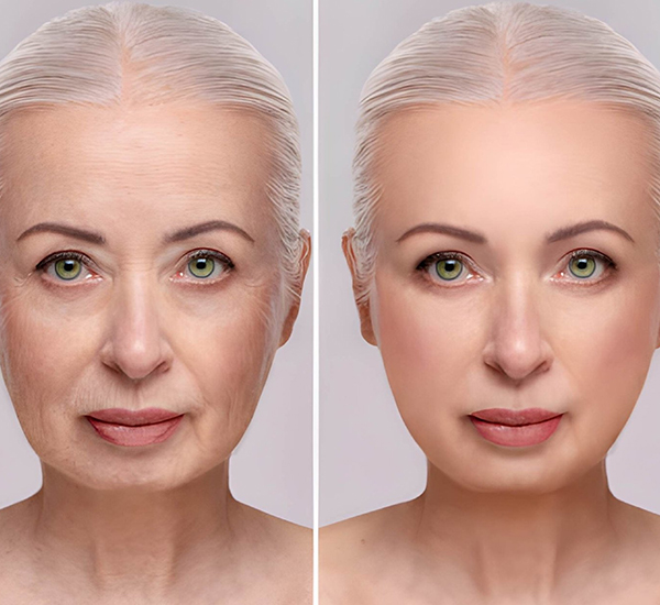 Facelift Surgery treatment at WFY Plastic Surgery