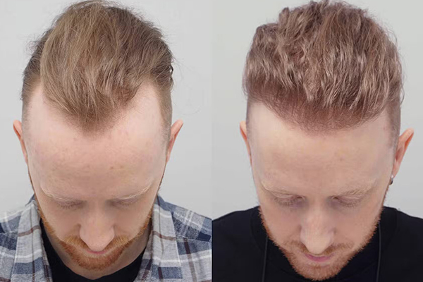 FUE Hair Transplant in Gurgaon