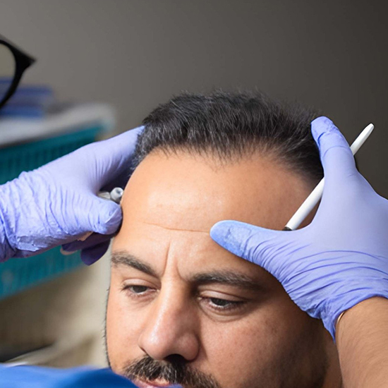 FUT Hair Transplant Clinic in Gurgaon at WFY Plastic Surgery
