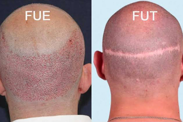 FUT Hair Transplant in Gurgaon