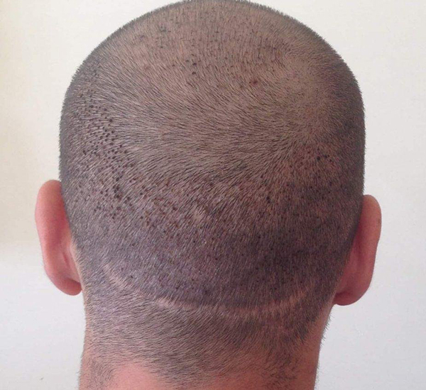 FUT Hair Transplant treatment at WFY Plastic Surgery