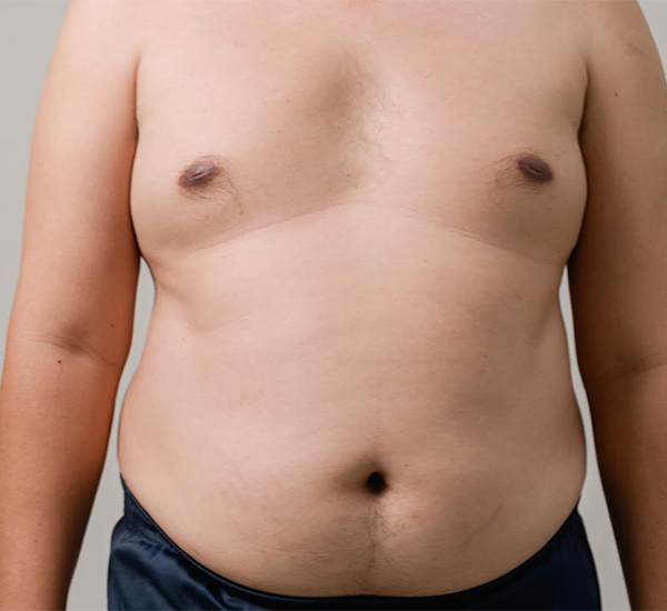 Gynecomastia treatment at WFY Plastic Surgery