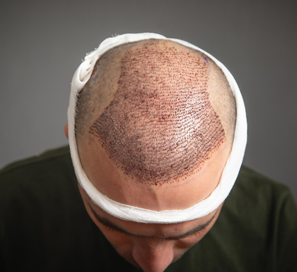 Hair Transplant treatment at WFY Plastic Surgery