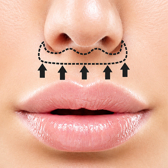 Lip Lift Surgery at WFY Plastic Surgery