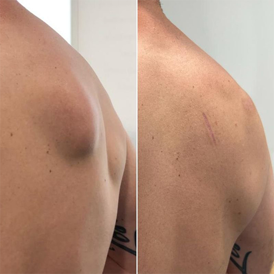 Lipoma Removal Surgery at WFY Plastic Surgery