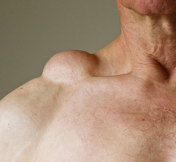 Lipoma removal surgery consultation and treatment planning