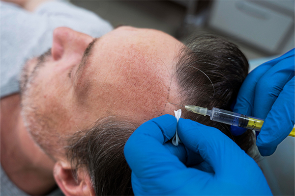 PRP Therapy in Gurgaon