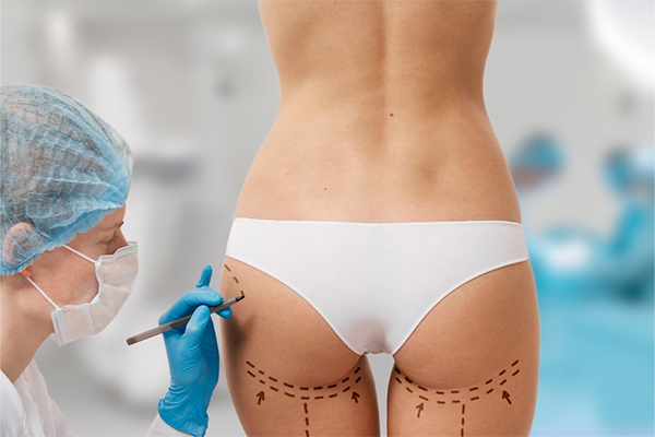 Silicone Butt Implant Surgery in Gurgaon