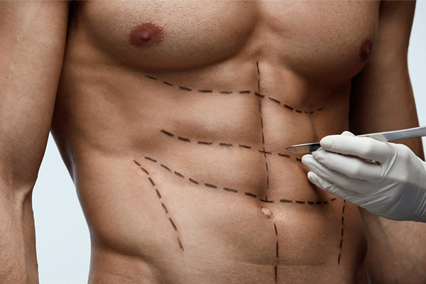 6 Pack Abs Surgery Abdominal Etching in Gurgaon