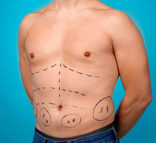 6 Pack Abs Surgery consultation and treatment planning