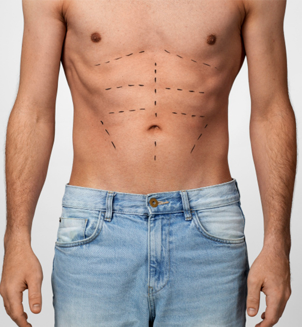 6 Pack Abs Surgery Abdominal Etching treatment at WFY Plastic Surgery