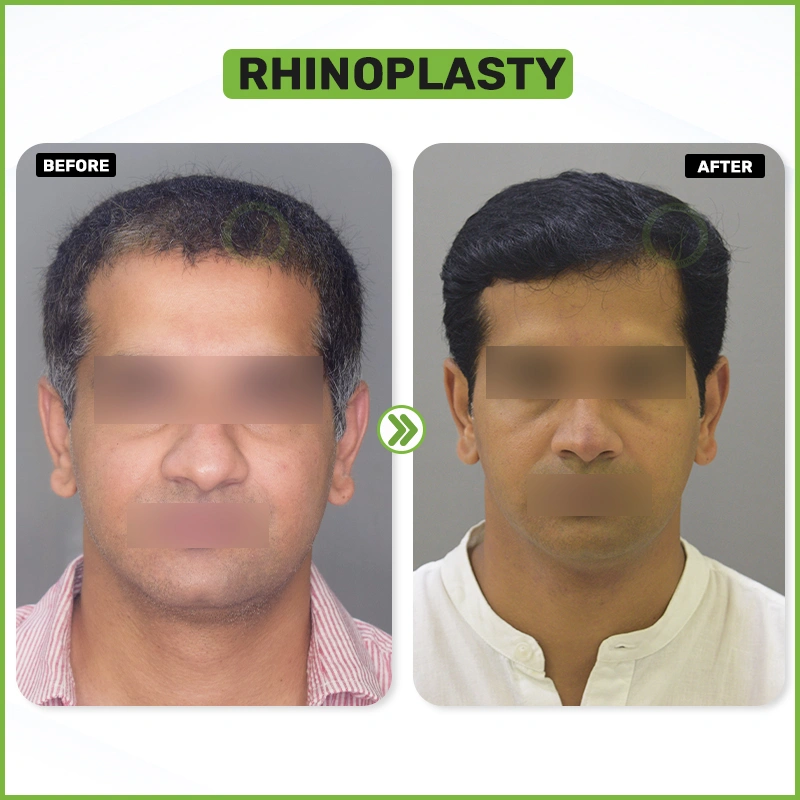 RHINOPLASTY Before and after