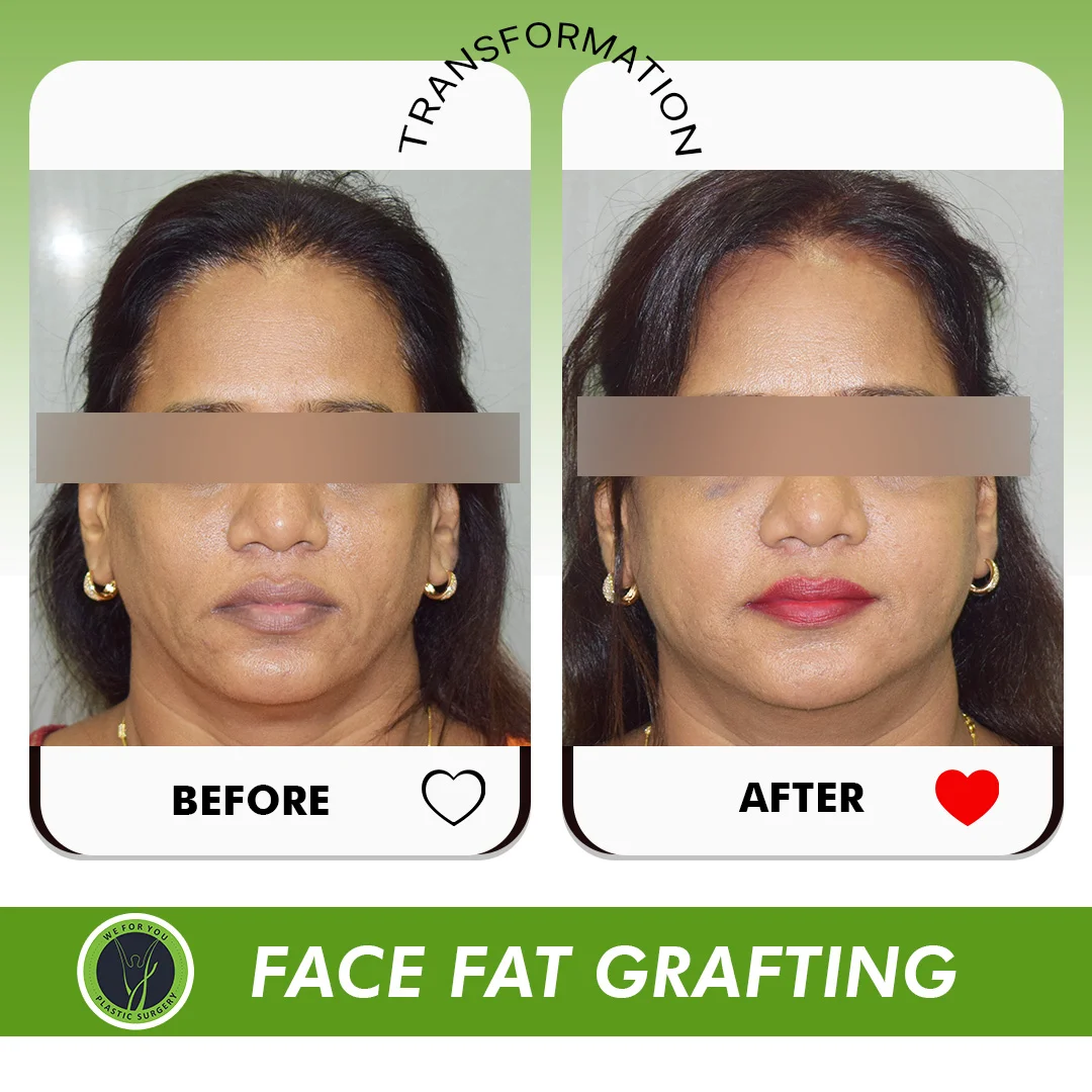 Face Grafting