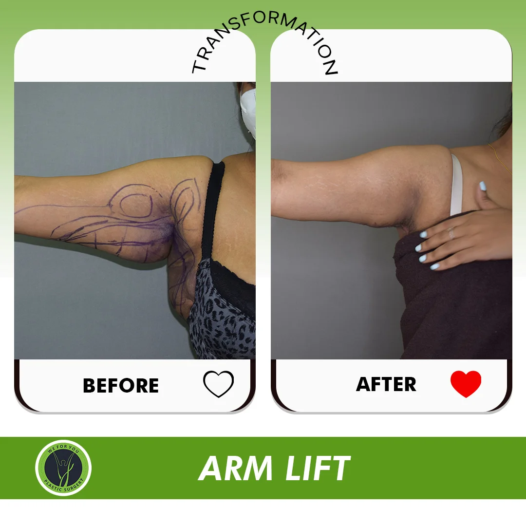 ARM LIFT before and after