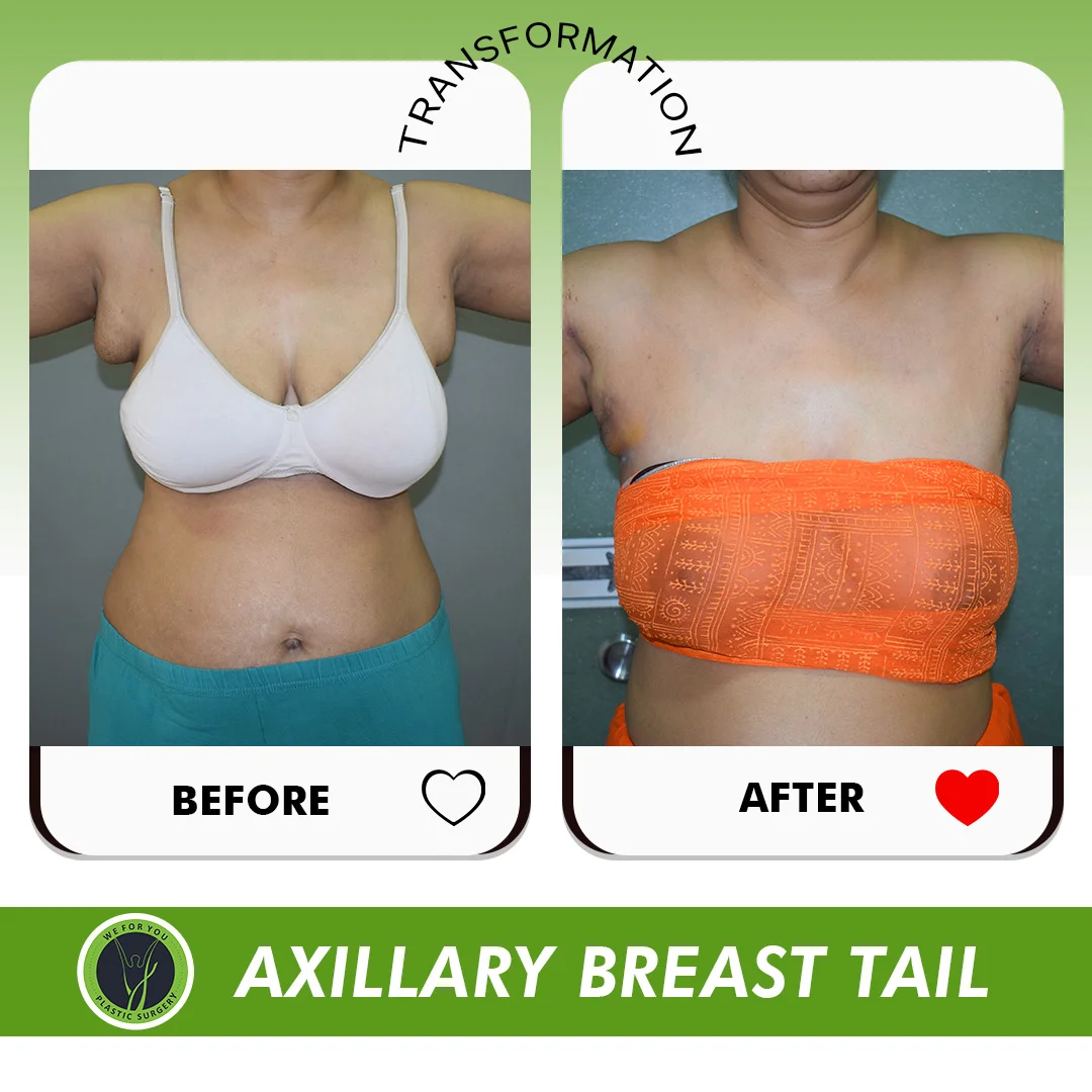 AXILLARY BREAST Before and after 