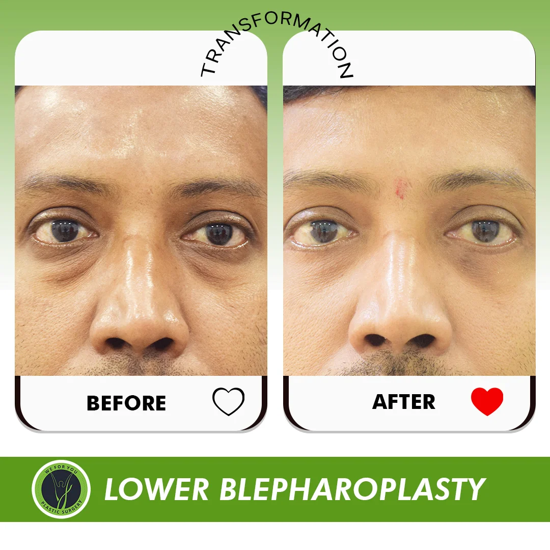 lower blepharoplasty Before and after