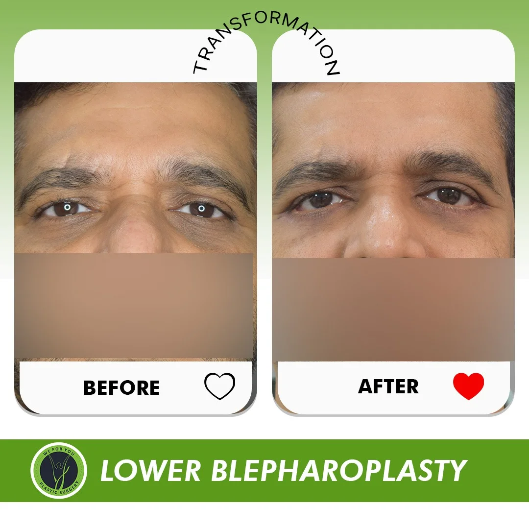 lower blepharoplasty Before and after