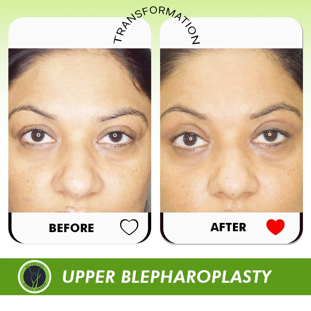 Upper Blepharoplasty Eyelid