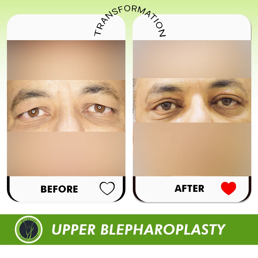 Upper Blepharoplasty Eyelid