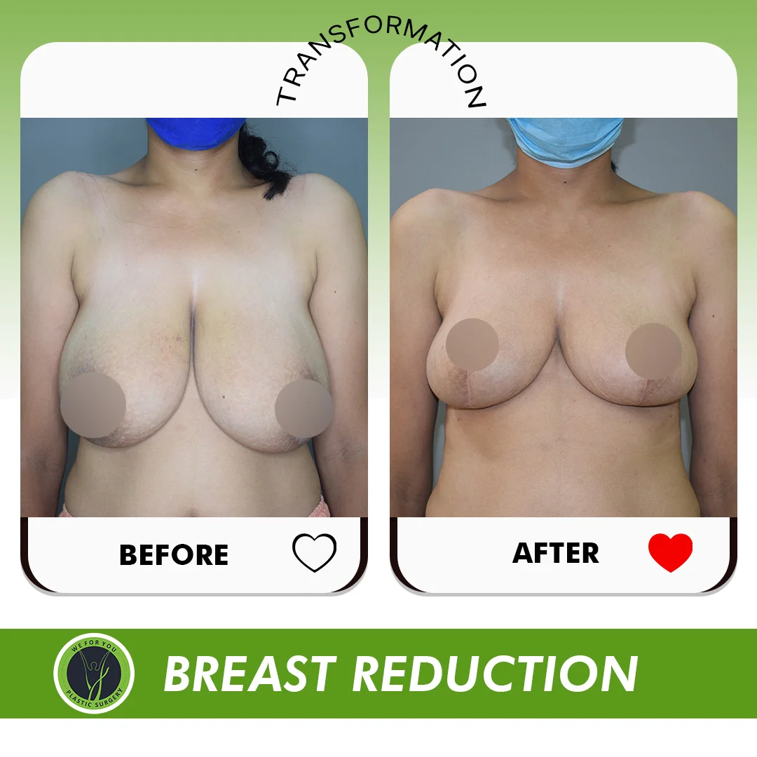 breast Reduction Before and after
