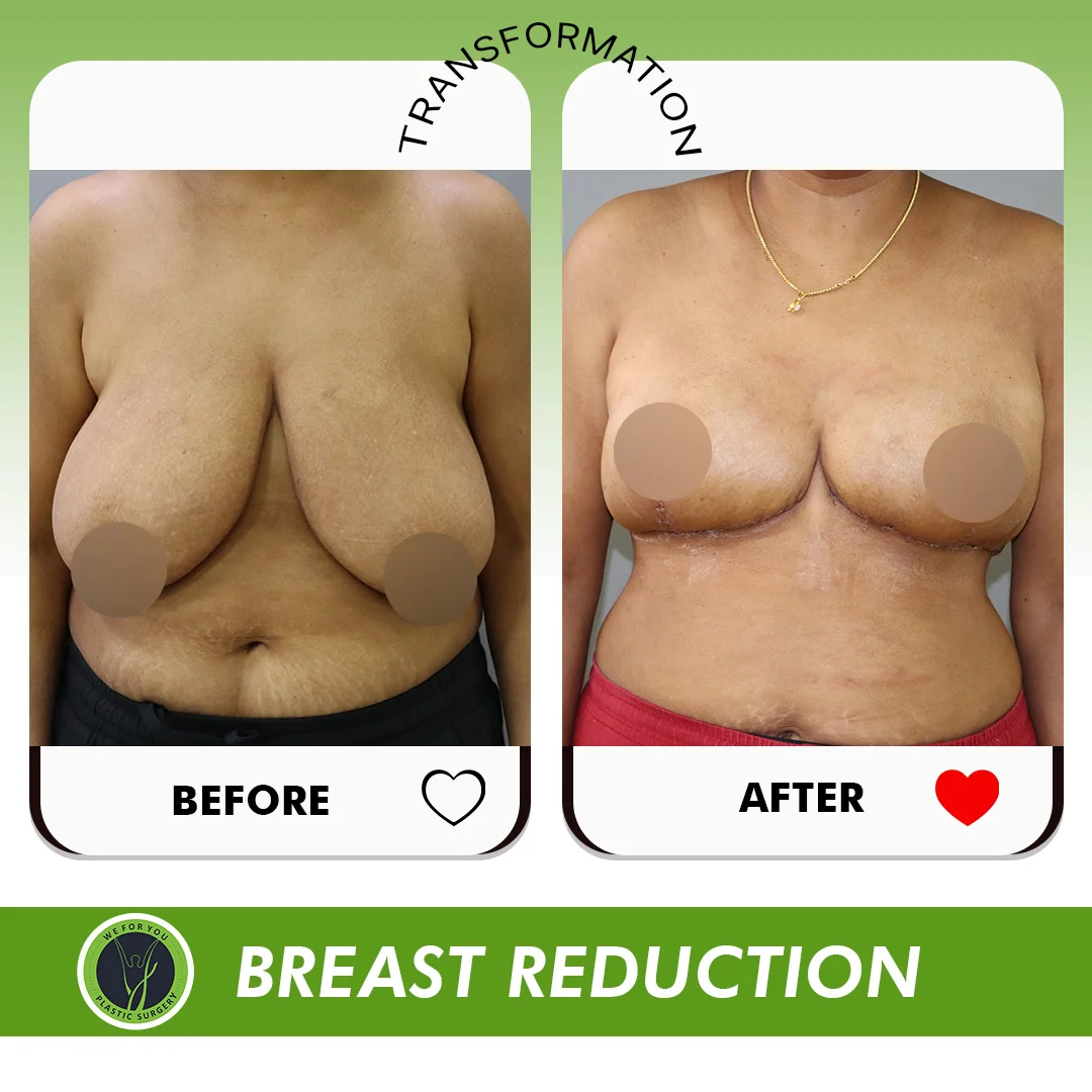 Female areola reduction before and after