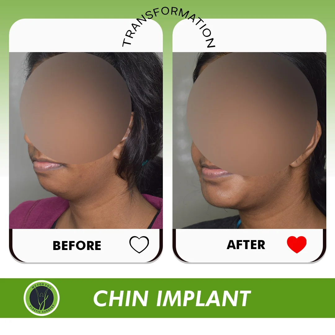 chin implant Before and after