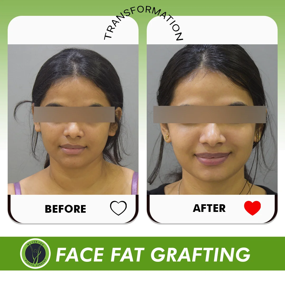 Face Fat Grafting Before and after