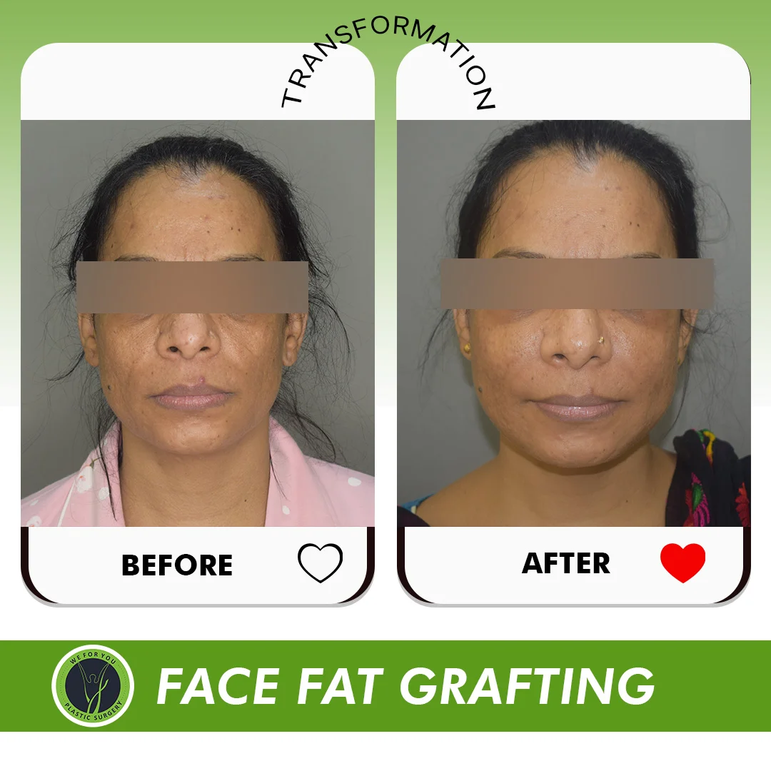 Face Fat Grafting Before and after