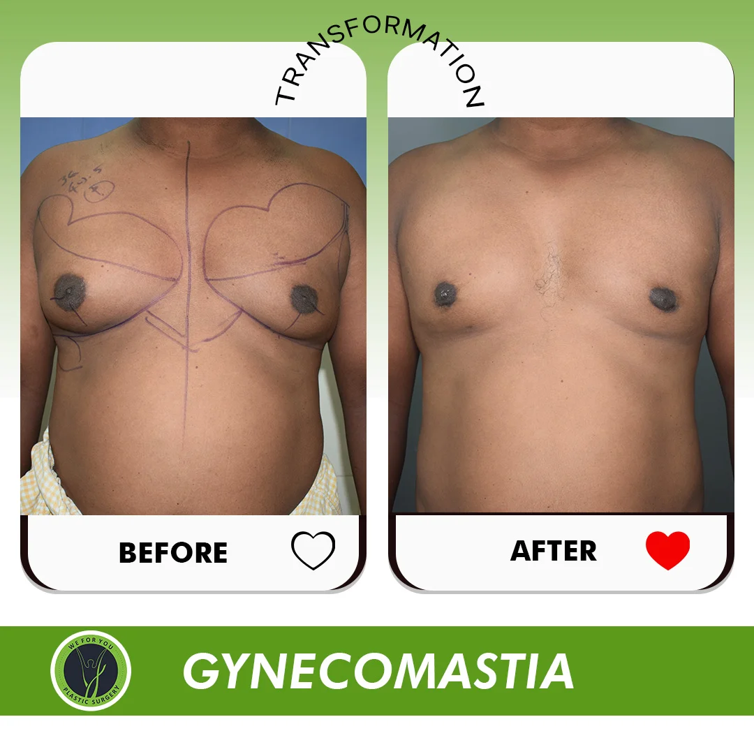 Gynecomastia 